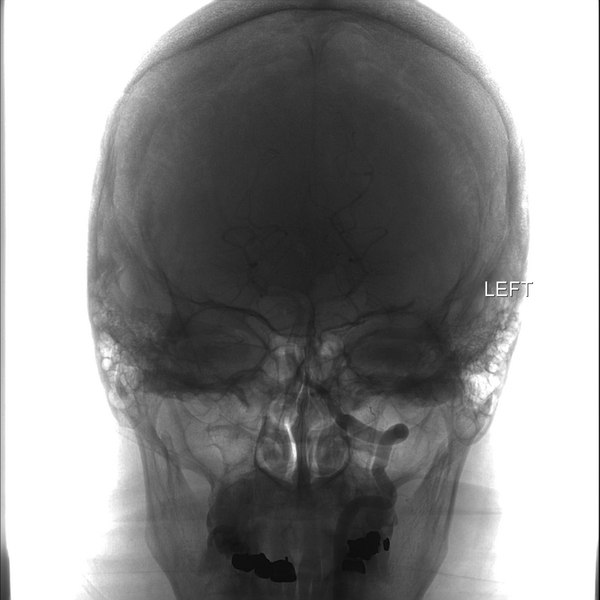 File:Normal cerebral angiogram (four vessel DSA) (Radiopaedia 41708-44649 LT VERT Ref 1).png