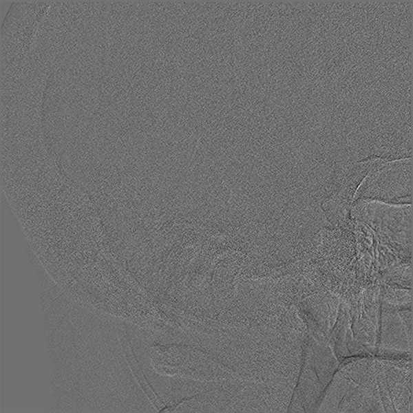 File:Normal cerebral angiogram (four vessel DSA) (Radiopaedia 41708-44649 O 3).png