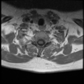 Normal cervical and thoracic spine MRI (Radiopaedia 35630-37156 Axial T1 C+ 7).png