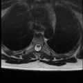 Normal cervical and thoracic spine MRI (Radiopaedia 35630-37156 H 32).png