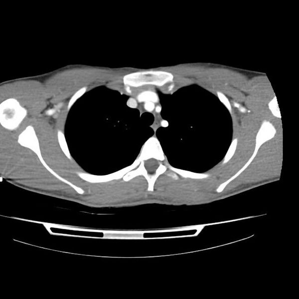 File:Normal dual-phase trauma CT chest,abdomen and pelvis (Radiopaedia 48092-52899 A 13).jpg