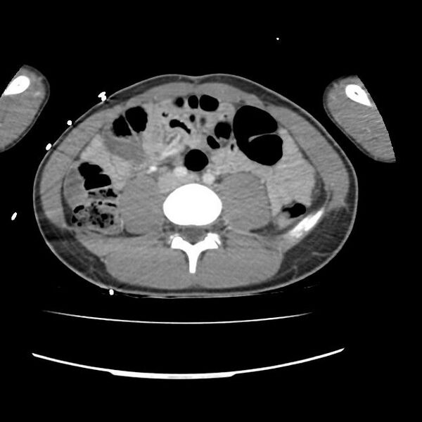 File:Normal dual-phase trauma CT chest,abdomen and pelvis (Radiopaedia 48092-52899 A 82).jpg