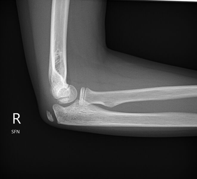 File:Normal elbow xrays - 13-year-old (Radiopaedia 26814-26981 Lateral 1).jpg