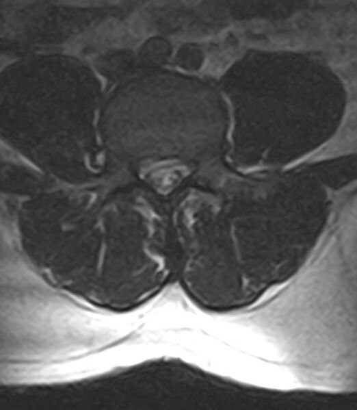 File:Normal lumbar spine MRI - low-field MRI scanner (Radiopaedia 40976-43699 Axial T2 67).jpg