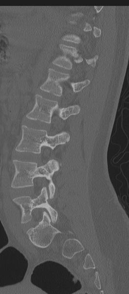 File:Normal lumbosacral CT (Radiopaedia 37923-39867 Sagittal bone window 37).png