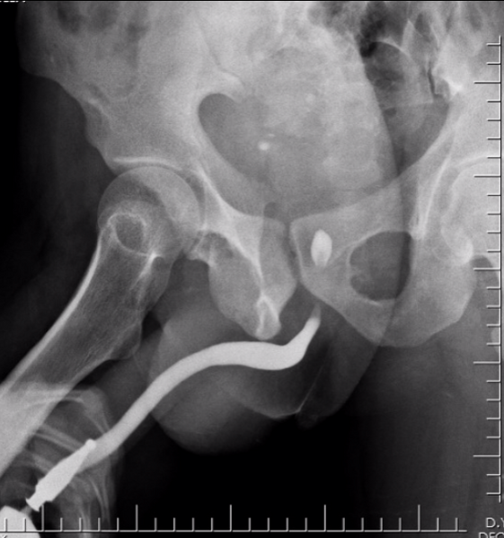 File:Normal retrograde urethrogram (Radiopaedia 27215-27391 B 1).PNG