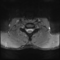 Normal trauma cervical spine (Radiopaedia 41017-43762 Axial T2 21).png