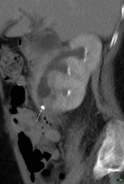 File:Obstructed infected horseshoe kidney (Radiopaedia 18116-17898 F 1).jpg
