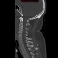Occipital condyle fracture (Radiopaedia 18366-18208 Sagittal bone window 17).jpg