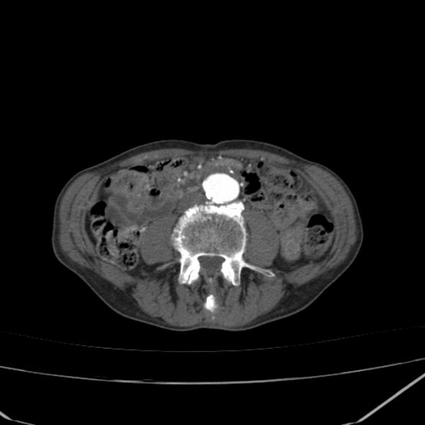 File:Abdominal aortic aneurysm (Radiopaedia 23703-23856 Axial C+ arterial phase 50).jpg
