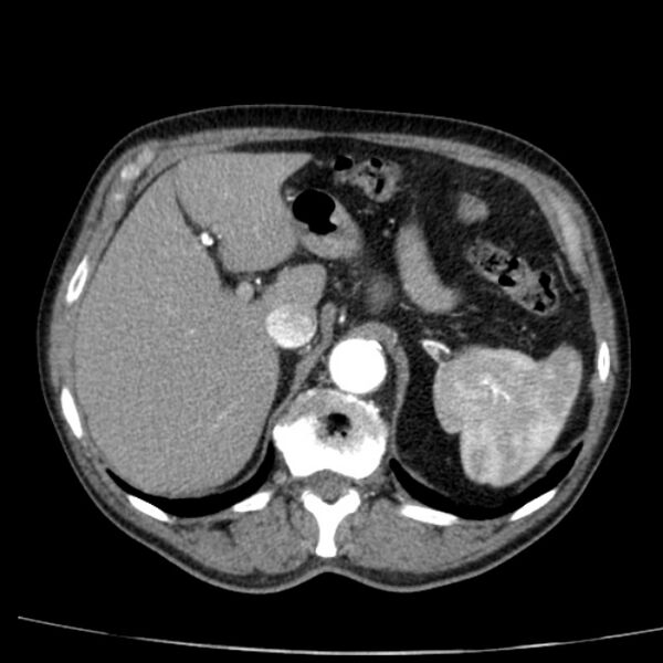 File:Abdominal aortic aneurysm (Radiopaedia 29248-29660 Axial C+ arterial phase 18).jpg