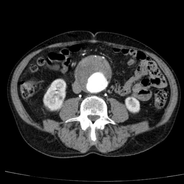 File:Abdominal aortic aneurysm (Radiopaedia 29248-29660 Axial C+ arterial phase 47).jpg