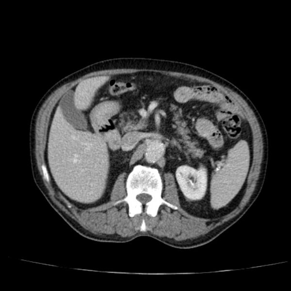 File:Abdominal aortic aneurysm (Radiopaedia 29248-29660 Axial C+ portal venous phase 23).jpg