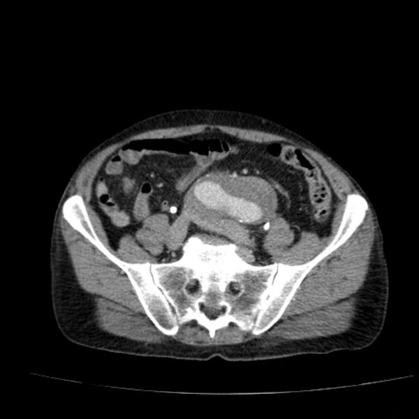 File:Abdominal aortic aneurysm (Radiopaedia 29248-29660 Axial C+ portal venous phase 45).jpg