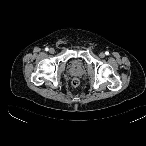 File:Abdominal aortic aneurysm (Radiopaedia 75131-86203 Axial C+ arterial phase 46).jpg