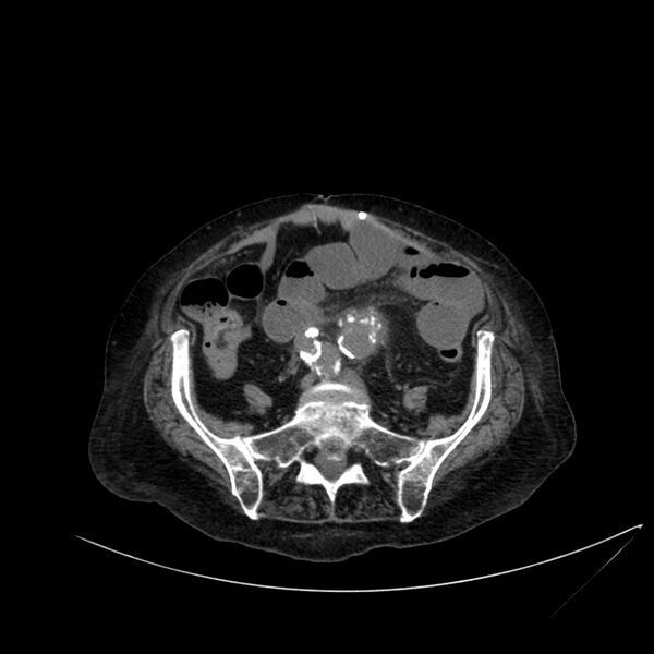 File:Abdominal aortic aneurysm - impending rupture (Radiopaedia 19233-19246 Axial non-contrast 89).jpg