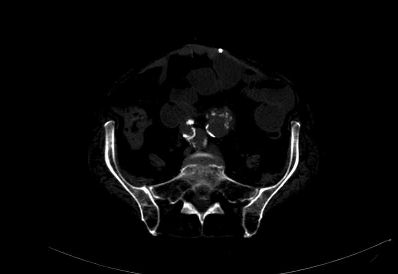 File:Abdominal aortic aneurysm - impending rupture (Radiopaedia 19233-19246 B 39).jpg