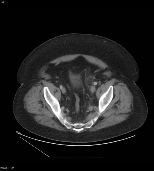 File:Abdominal aortic aneurysm with intramural hematoma then rupture (Radiopaedia 50278-55631 Axial C+ arterial phase 109).jpg