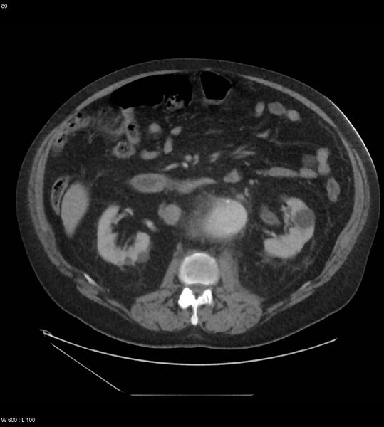 File:Abdominal aortic aneurysm with intramural hematoma then rupture (Radiopaedia 50278-55631 Axial C+ arterial phase 71).jpg