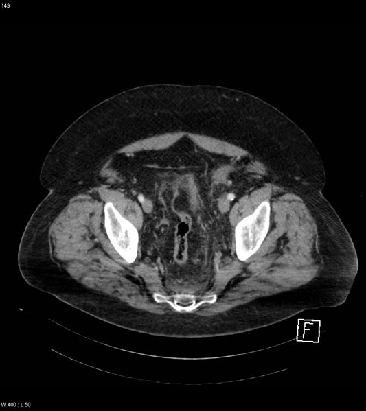 File:Abdominal aortic aneurysm with intramural hematoma then rupture (Radiopaedia 50278-55632 Axial C+ arterial phase 148).jpg