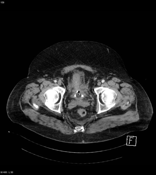 File:Abdominal aortic aneurysm with intramural hematoma then rupture (Radiopaedia 50278-55632 Axial C+ arterial phase 158).jpg