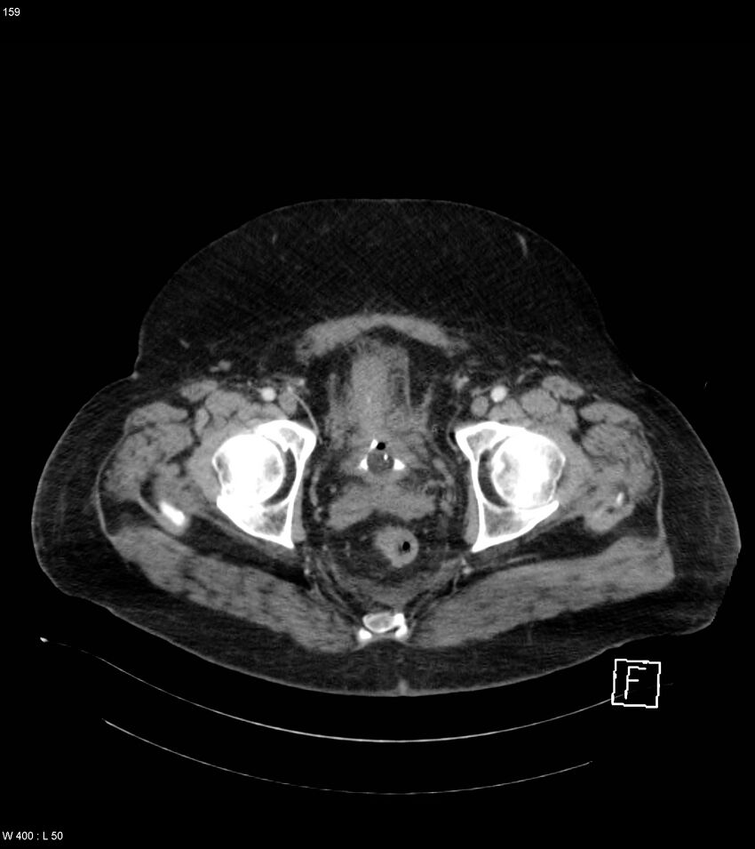 Abdominal aortic aneurysm with intramural hematoma then rupture (Radiopaedia 50278-55632 Axial C+ arterial phase 158).jpg
