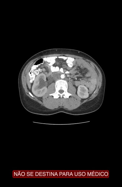 File:Abdominal desmoid tumor (Radiopaedia 44024-47540 Axial C+ arterial phase 11).jpg