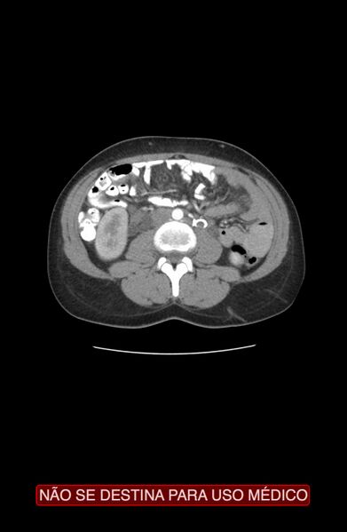 File:Abdominal desmoid tumor (Radiopaedia 44024-47540 Axial C+ arterial phase 15).jpg