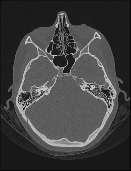 File:Aberrant right internal carotid artery (Radiopaedia 65191-74198 Axial non-contrast 54).jpg