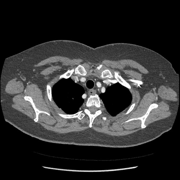 File:Aberrant right subclavian and left vertebral arteries (Radiopaedia 43467-46847 Axial C+ portal venous phase 18).jpg