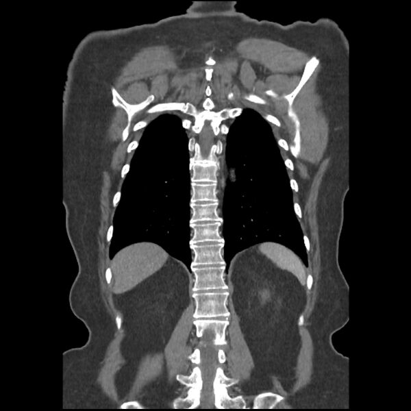 File:Aberrant right subclavian and left vertebral arteries (Radiopaedia 43467-46847 Coronal C+ portal venous phase 69).jpg