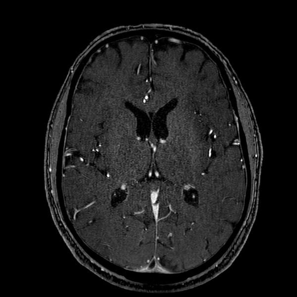 File:Accessory middle cerebral artery (Radiopaedia 73114-83828 Axial MRA 115).jpg