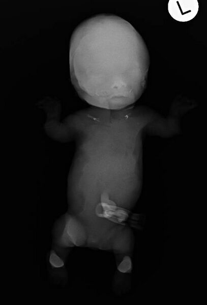 File:Achondrogenesis (Radiopaedia 38416-40494 Babygram 1).jpg