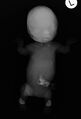 Achondrogenesis (Radiopaedia 38416-40494 Babygram 1).jpg