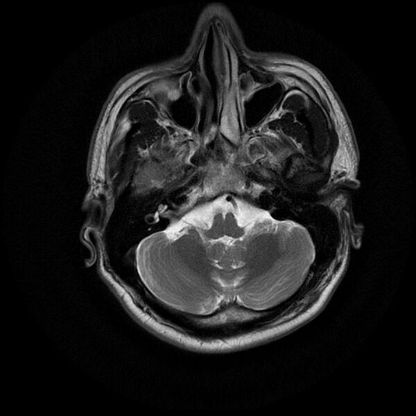 File:Acoustic schwannoma - intracanalicular (Radiopaedia 37247-39024 Axial T2 5).jpg