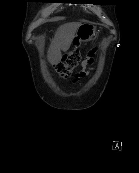 File:Active lower gastrointestinal bleeding - diverticular (Radiopaedia 61203-69106 Coronal C+ arterial phase 13).jpg