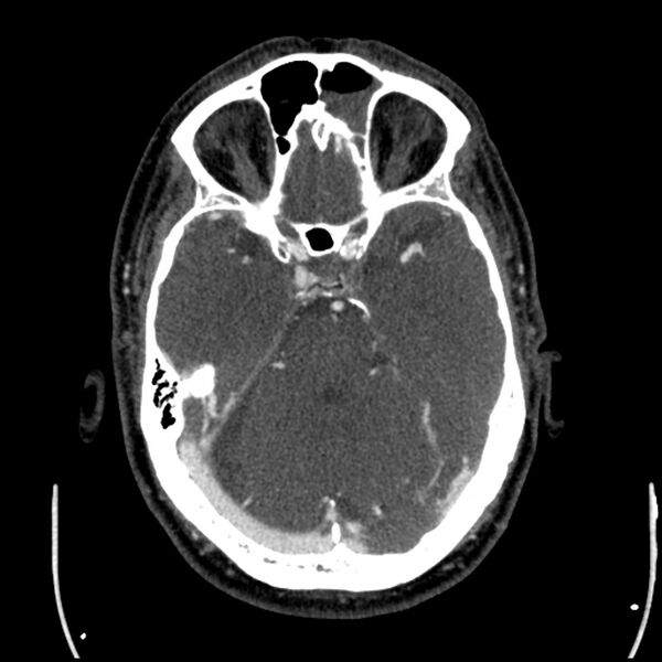 File:Acute A3 occlusion with ACA ischemic penumbra (CT perfusion) (Radiopaedia 72036-82527 Axial C+ arterial phase thins 119).jpg
