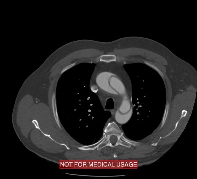 File:Acute aortic dissection - Stanford type A (Radiopaedia 40661-43285 Axial C+ arterial phase 10).jpg