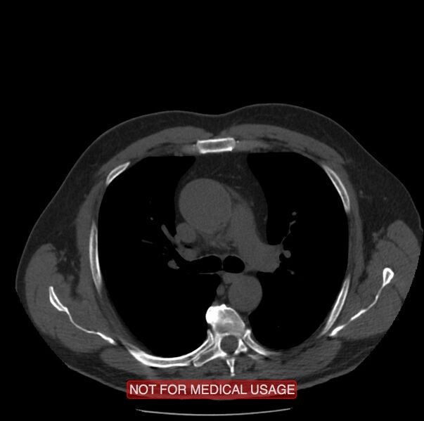File:Acute aortic dissection - Stanford type A (Radiopaedia 40661-43285 Axial non-contrast 17).jpg