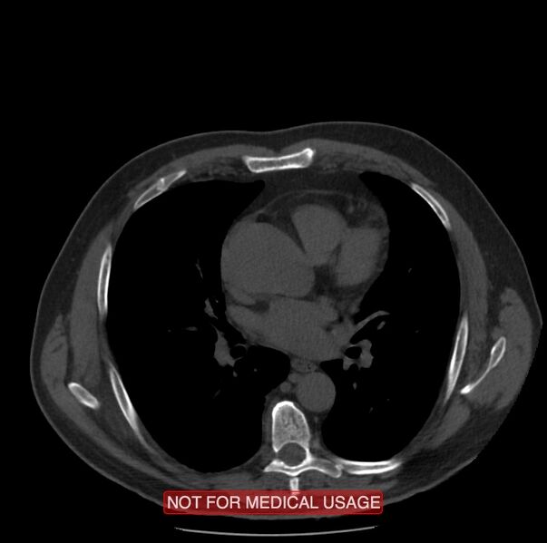 File:Acute aortic dissection - Stanford type A (Radiopaedia 40661-43285 Axial non-contrast 31).jpg
