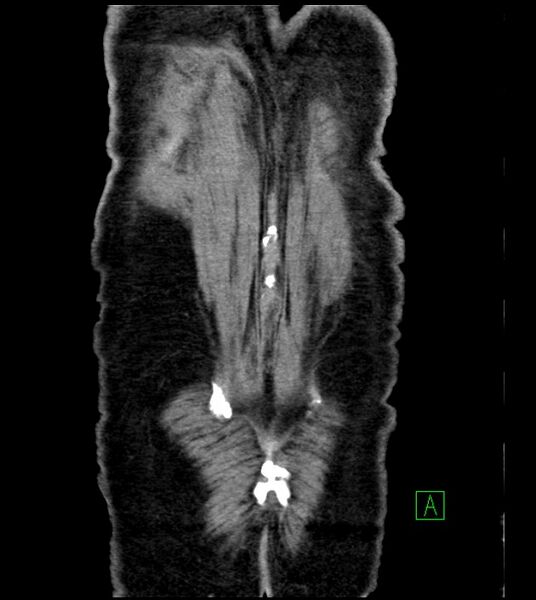 File:Acute arterial mesenteric ischemia (Radiopaedia 78238-90828 Coronal C+ portal venous phase 85).jpg