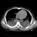 Acute aspiration pneumonitis (Radiopaedia 33605-34703 Axial non-contrast 55).jpg