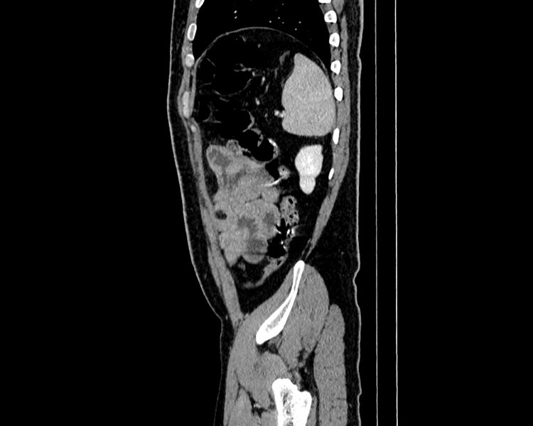 File:Acute cholecystitis (Radiopaedia 53216-59182 Sagittal C+ portal venous phase 20).jpg