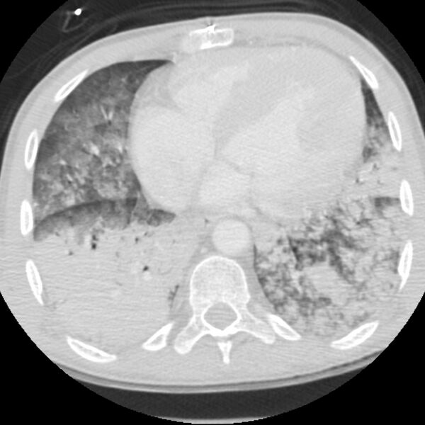 File:Acute diffuse alveolar hemorrhage (Radiopaedia 41323-44158 Axial lung window 43).jpg
