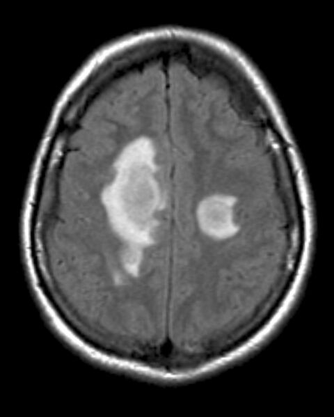 File:Acute disseminated encephalomyelitis (Radiopaedia 2576-6271 Axial FLAIR 1).jpg