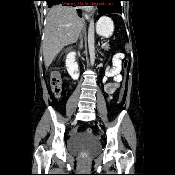 File:Acute gangrenous cholecystitis (Radiopaedia 10123-10661 Coronal C+ portal venous phase 23).jpg