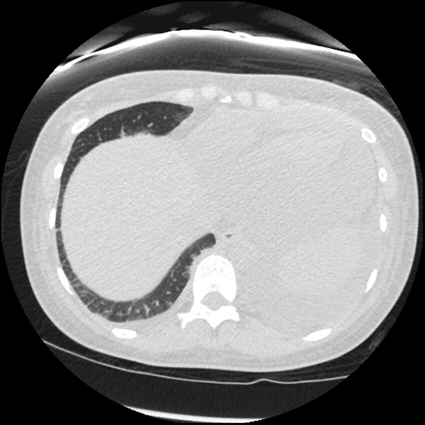 Acute lupus nephritis (Radiopaedia 45832-50107 Axial lung window 80).jpg