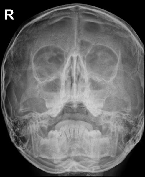 File:Acute maxillary sinusitis (Radiopaedia 67098).jpg