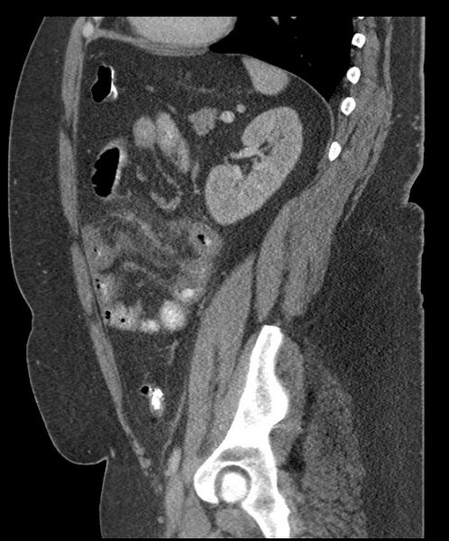 File:Acute mesenteric venous ischemia (Radiopaedia 46041-50383 Sagittal C+ portal venous phase 80).jpg