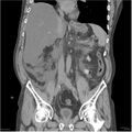 Acute pancreatitis (Radiopaedia 19135-19116 Coronal non-contrast 24).jpg